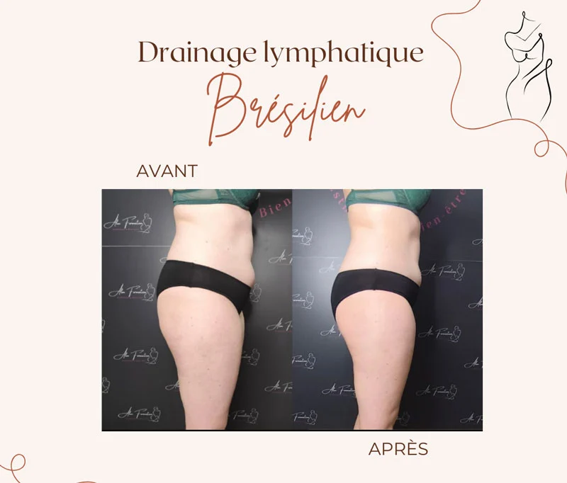 Drainage Brésilien